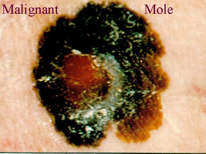 Malignant Mole 