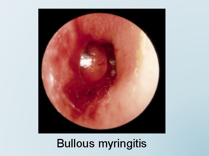 Bullous myringitis 