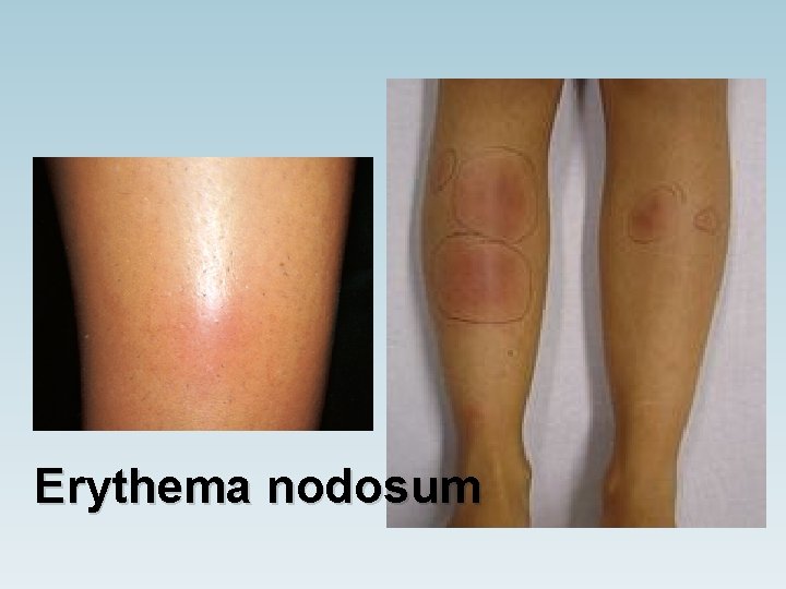 Erythema nodosum 