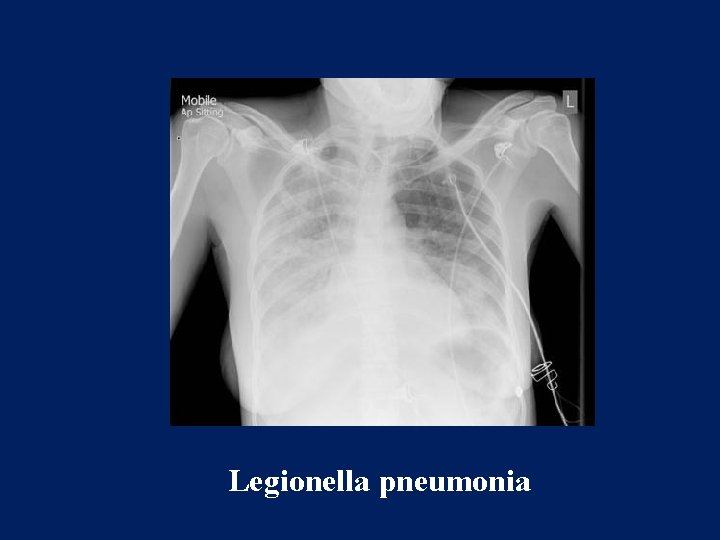 Legionella pneumonia 