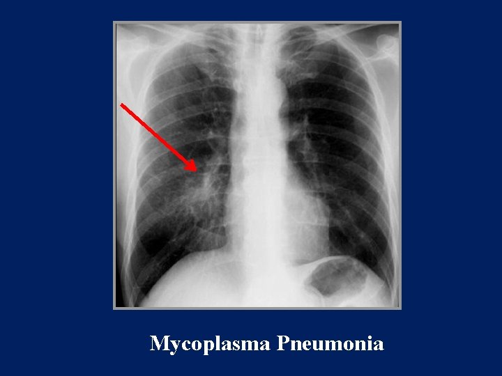 Mycoplasma Pneumonia 