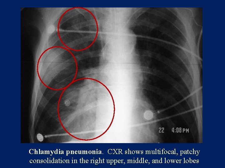 Chlamydia pneumonia. CXR shows multifocal, patchy consolidation in the right upper, middle, and lower