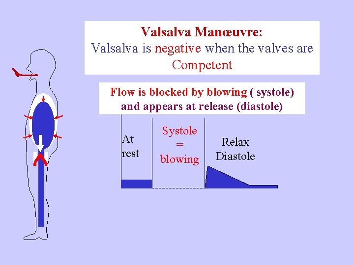 Valsalva Manœuvre: Valsalva is negative when the valves are Competent Flow is blocked by