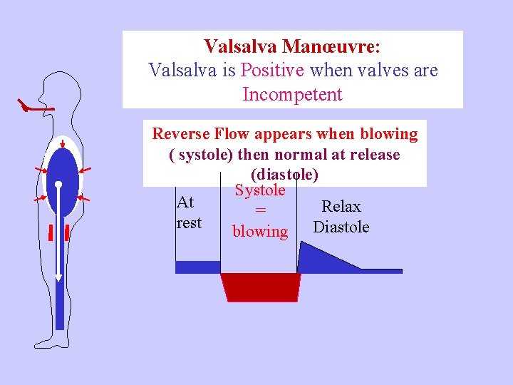 Valsalva Manœuvre: Valsalva is Positive when valves are Incompetent Reverse Flow appears when blowing