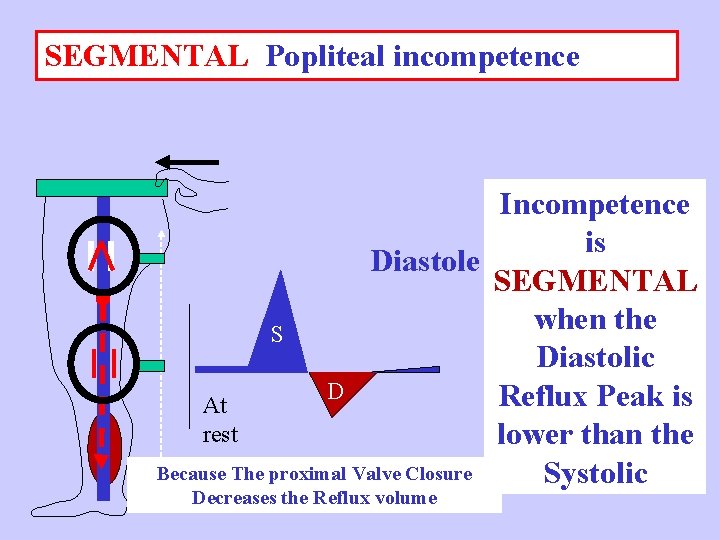 SEGMENTAL Popliteal incompetence Incompetence is Diastole SEGMENTAL when the S Diastolic D Reflux Peak