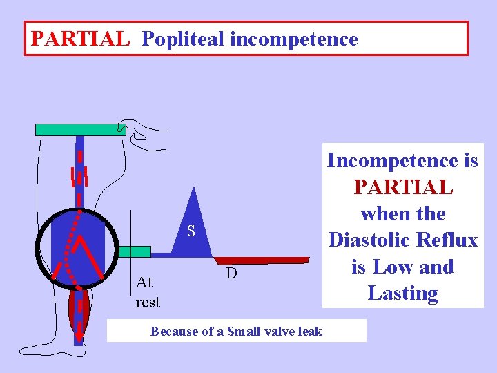 PARTIAL Popliteal incompetence S At rest D Because of a Small valve leak Incompetence
