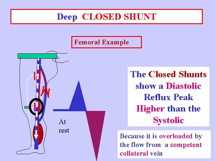 Deep CLOSED SHUNT Femoral Example At rest The Closed Shunts show a Diastolic Reflux