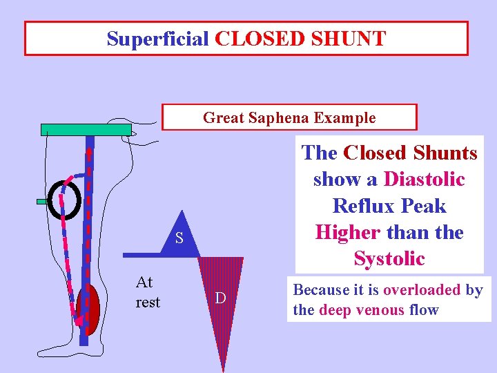 Superficial CLOSED SHUNT Great Saphena Example The Closed Shunts show a Diastolic Reflux Peak