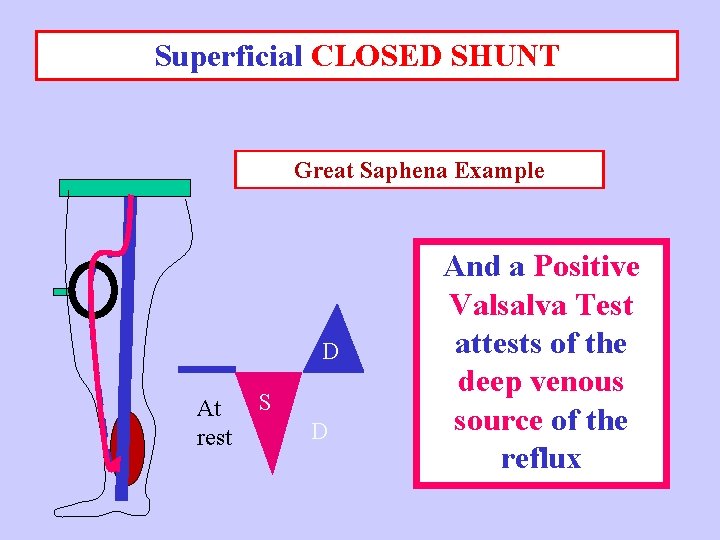 Superficial CLOSED SHUNT Great Saphena Example D At rest S D And a Positive