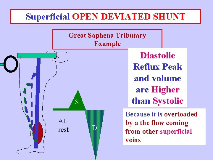 Superficial OPEN DEVIATED SHUNT Great Saphena Tributary Example Diastolic Reflux Peak and volume are