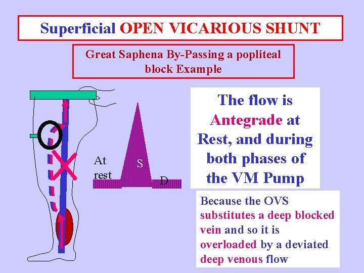Superficial OPEN VICARIOUS SHUNT Great Saphena By-Passing a popliteal block Example At rest S