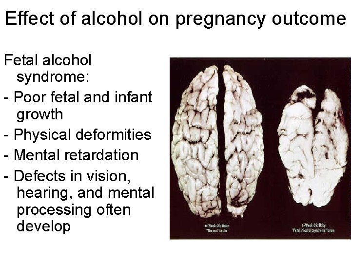 Effect of alcohol on pregnancy outcome Fetal alcohol syndrome: - Poor fetal and infant