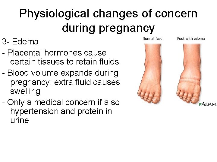 Physiological changes of concern during pregnancy 3 - Edema - Placental hormones cause certain