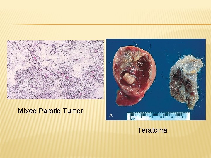 Mixed Parotid Tumor Teratoma 