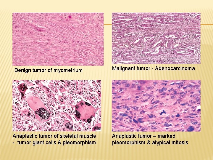 Benign tumor of myometrium Anaplastic tumor of skeletal muscle - tumor giant cells &