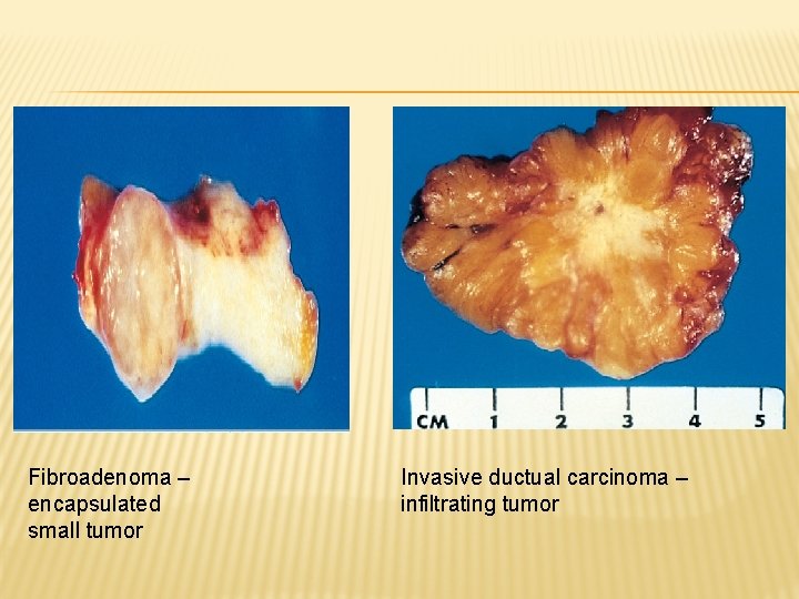 Fibroadenoma – encapsulated small tumor Invasive ductual carcinoma – infiltrating tumor 
