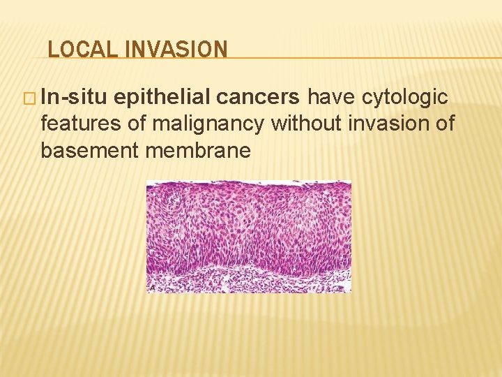 LOCAL INVASION � In-situ epithelial cancers have cytologic features of malignancy without invasion of