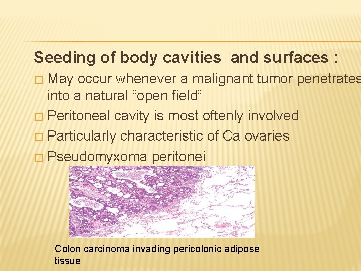 Seeding of body cavities and surfaces : May occur whenever a malignant tumor penetrates