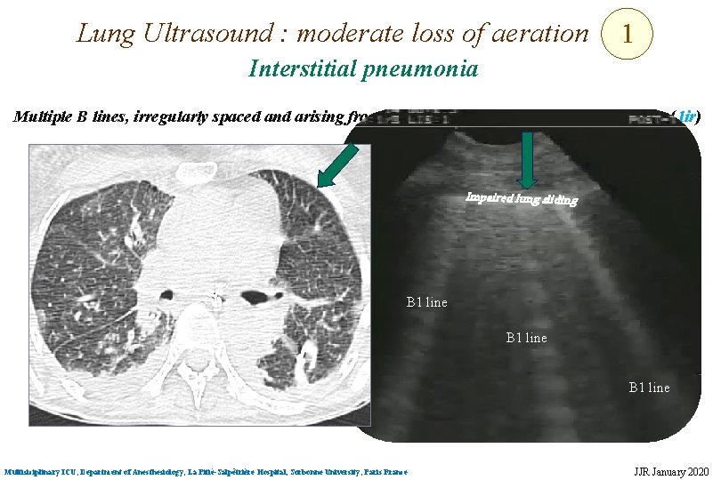 Lung Ultrasound : moderate loss of aeration 1 Interstitial pneumonia Multiple B lines, irregularly