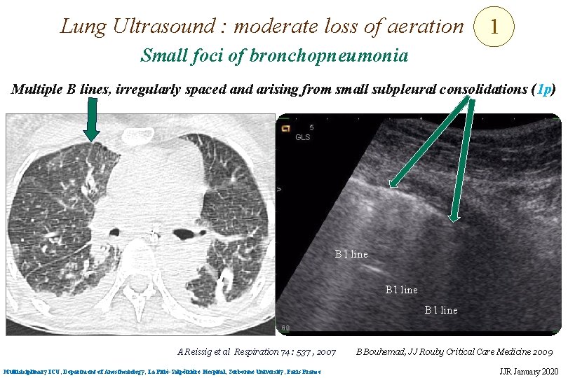 Lung Ultrasound : moderate loss of aeration 1 Small foci of bronchopneumonia Multiple B