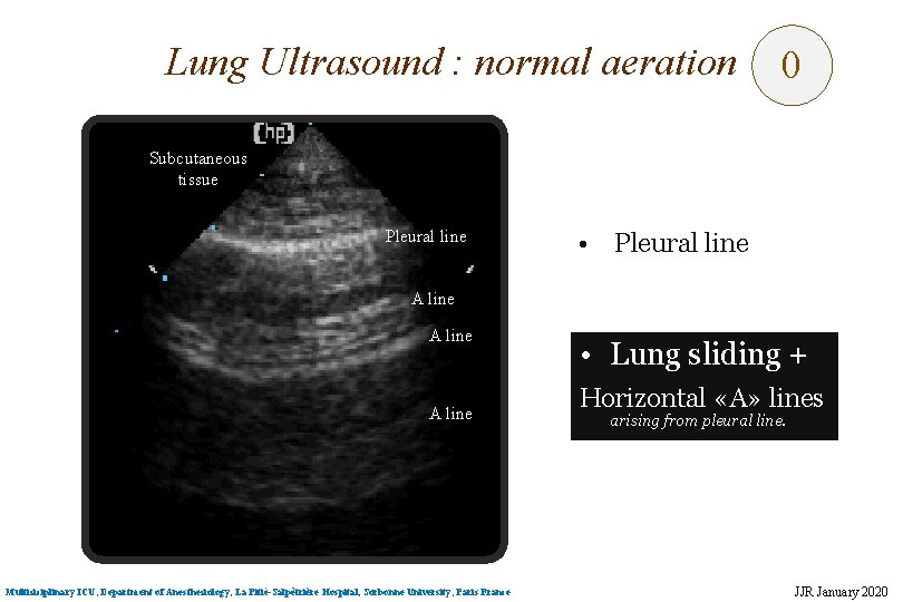 Lung Ultrasound : normal aeration 0 Subcutaneous tissue Pleural line • Pleural line A