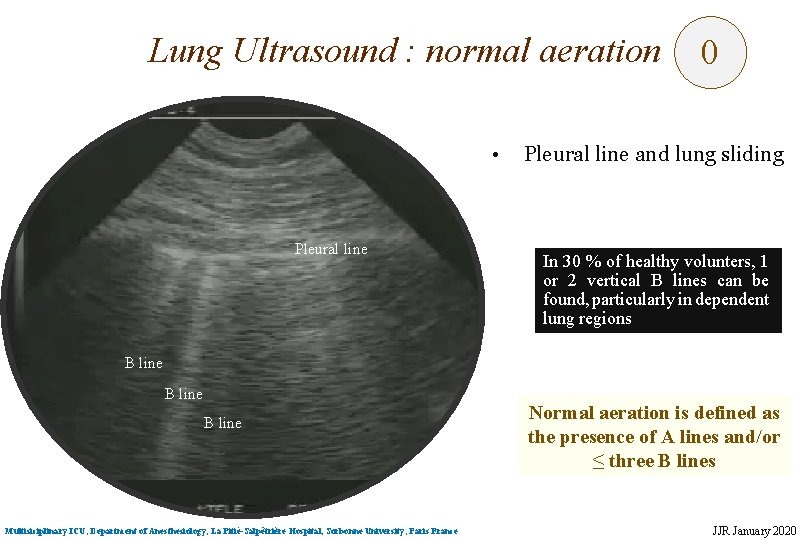 Lung Ultrasound : normal aeration • Pleural line 0 Pleural line and lung sliding