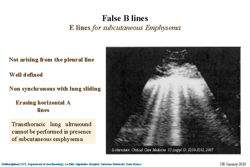 False B lines E lines for subcutaneous Emphysema Not arising from the pleural line