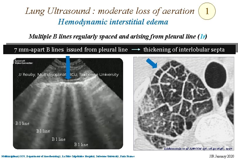 Lung Ultrasound : moderate loss of aeration 1 Hemodynamic interstitial edema Multiple B lines