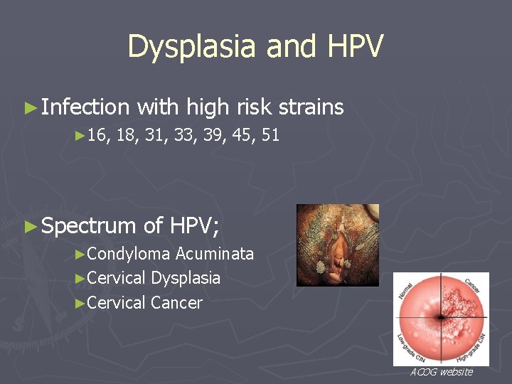 Dysplasia and HPV ► Infection ► 16, with high risk strains 18, 31, 33,