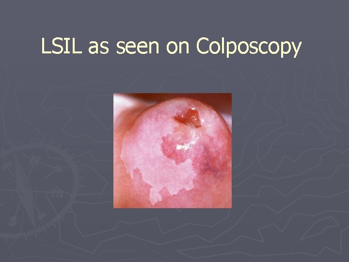 LSIL as seen on Colposcopy 