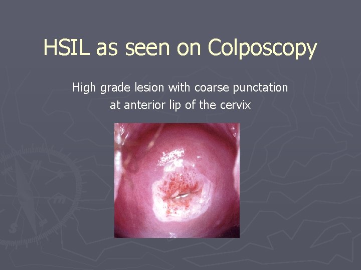 HSIL as seen on Colposcopy High grade lesion with coarse punctation at anterior lip