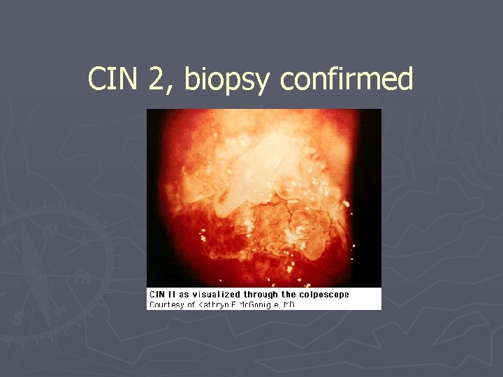 CIN 2, biopsy confirmed 
