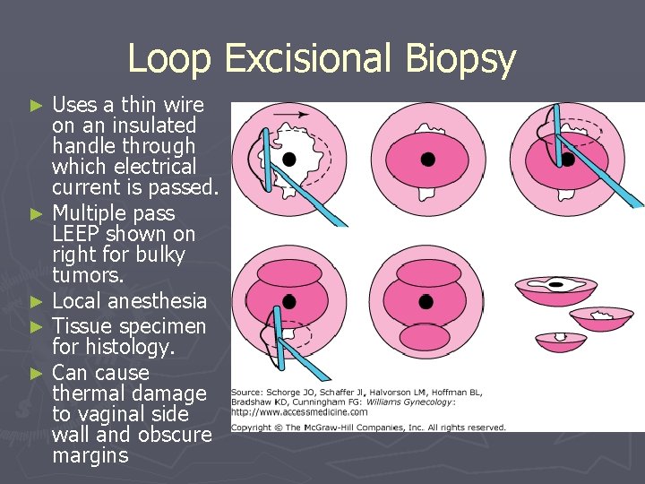 Loop Excisional Biopsy Uses a thin wire on an insulated handle through which electrical