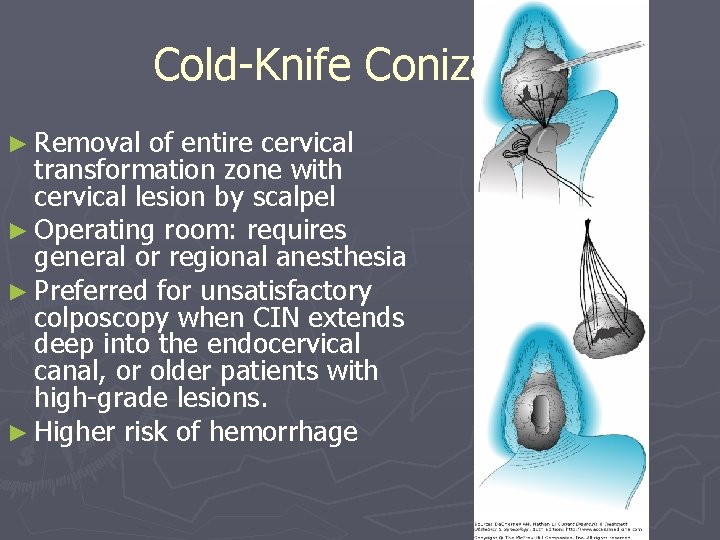 Cold-Knife Conization ► Removal of entire cervical transformation zone with cervical lesion by scalpel