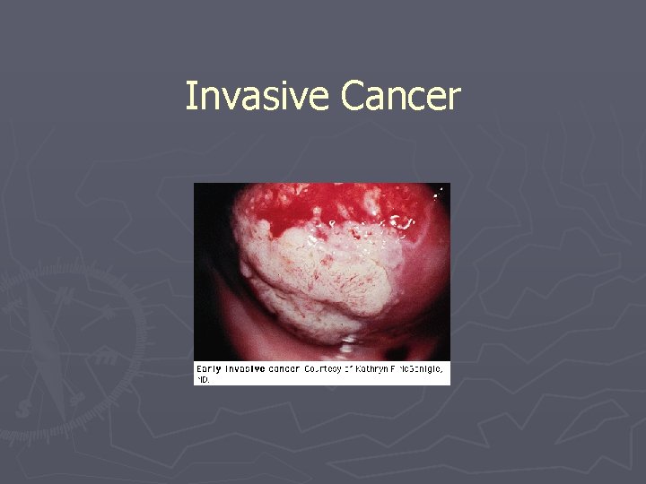 Invasive Cancer 