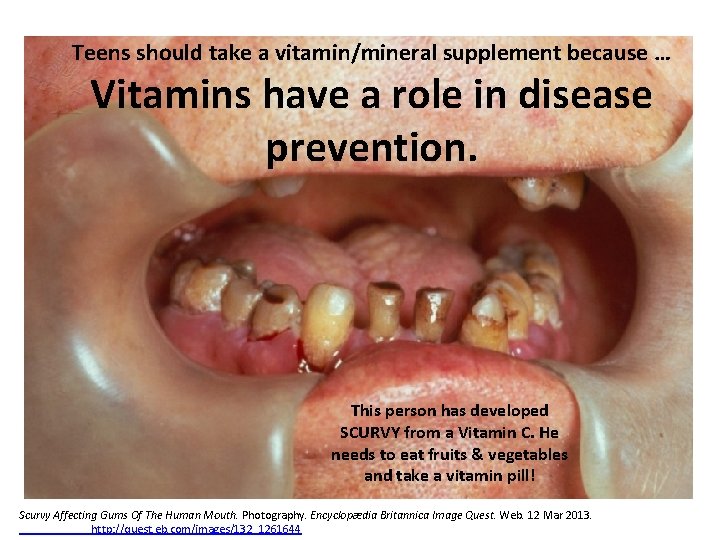 Teens should take a vitamin/mineral supplement because … Vitamins have a role in disease