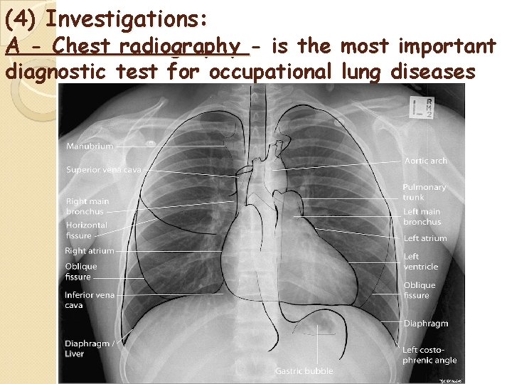 (4) Investigations: A - Chest radiography - is the most important diagnostic test for