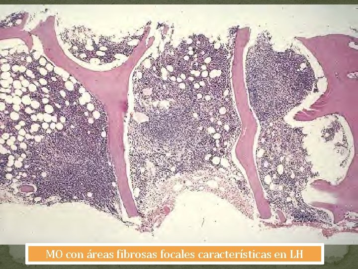 MO con áreas fibrosas focales características en LH 