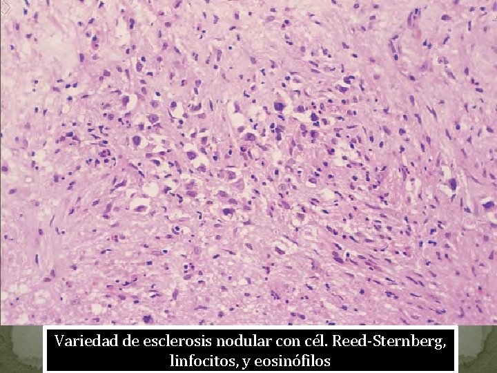 Variedad de esclerosis nodular con cél. Reed-Sternberg, linfocitos, y eosinófilos 