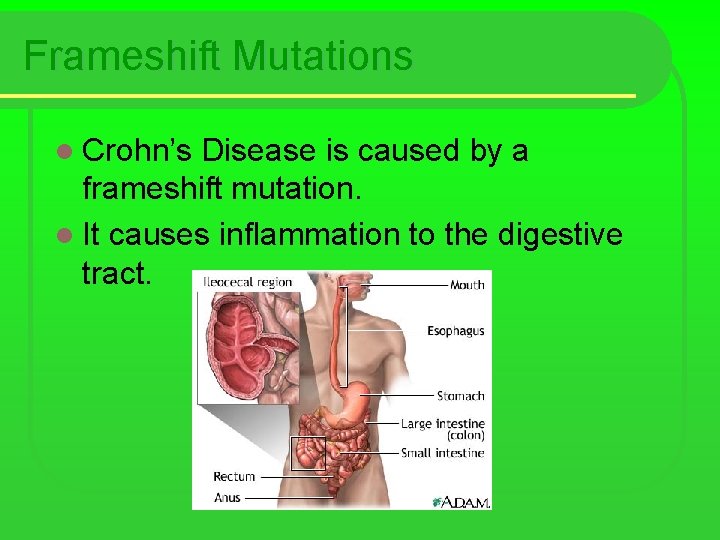 Frameshift Mutations l Crohn’s Disease is caused by a frameshift mutation. l It causes