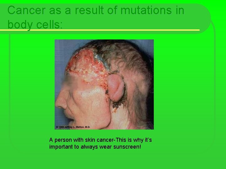 Cancer as a result of mutations in body cells: A person with skin cancer-This