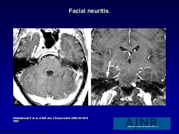 Facial neuritis. Hildenbrand P et al. AJNR Am J Neuroradiol 2009; 30: 10791087 ©