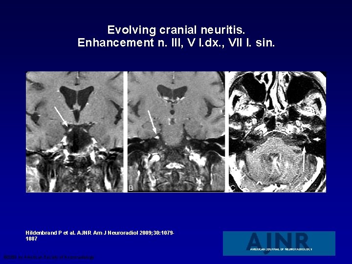 Evolving cranial neuritis. Enhancement n. III, V l. dx. , VII l. sin. Hildenbrand