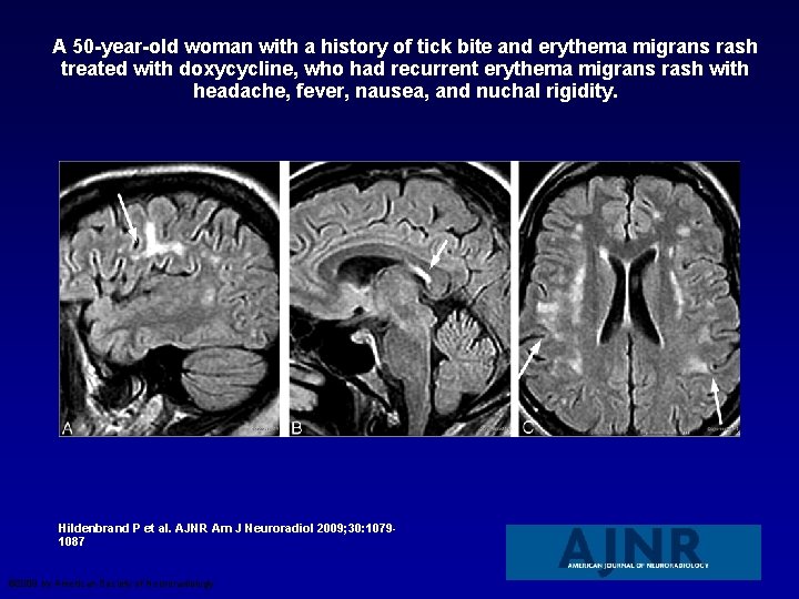 A 50 -year-old woman with a history of tick bite and erythema migrans rash