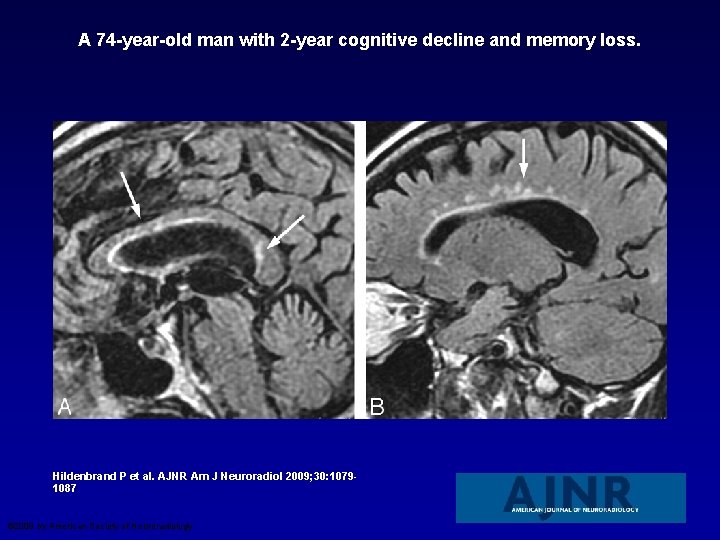 A 74 -year-old man with 2 -year cognitive decline and memory loss. Hildenbrand P