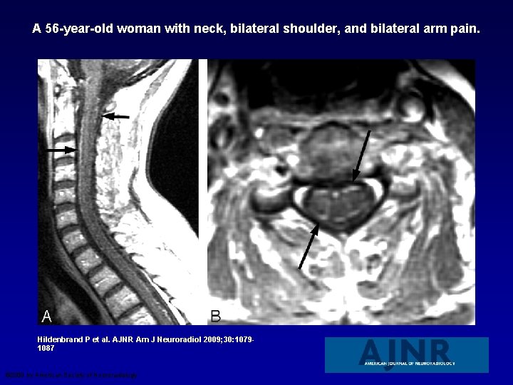 A 56 -year-old woman with neck, bilateral shoulder, and bilateral arm pain. Hildenbrand P