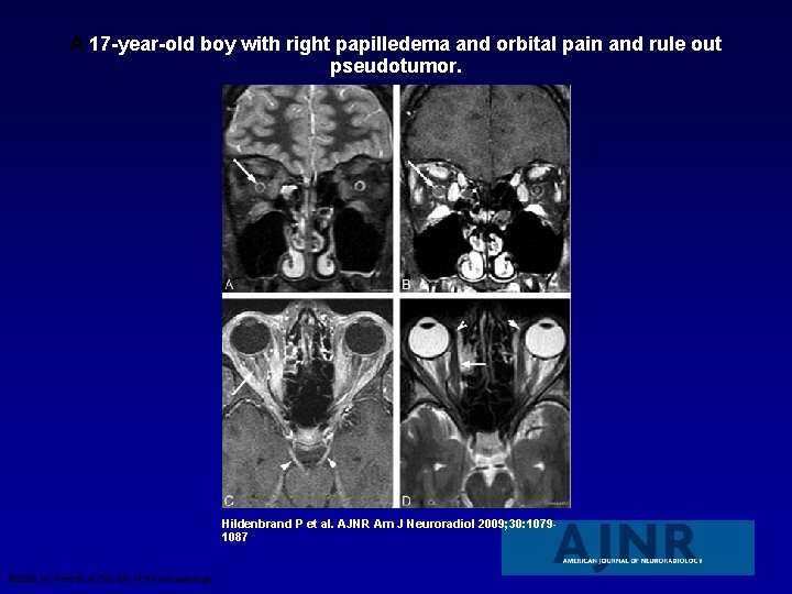 A 17 -year-old boy with right papilledema and orbital pain and rule out pseudotumor.