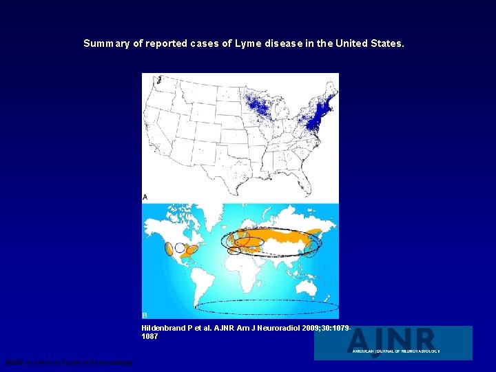 Summary of reported cases of Lyme disease in the United States. Hildenbrand P et