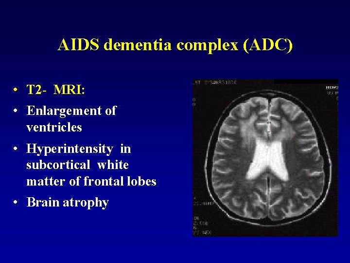 AIDS dementia complex (ADC) • T 2 - MRI: • Enlargement of ventricles •