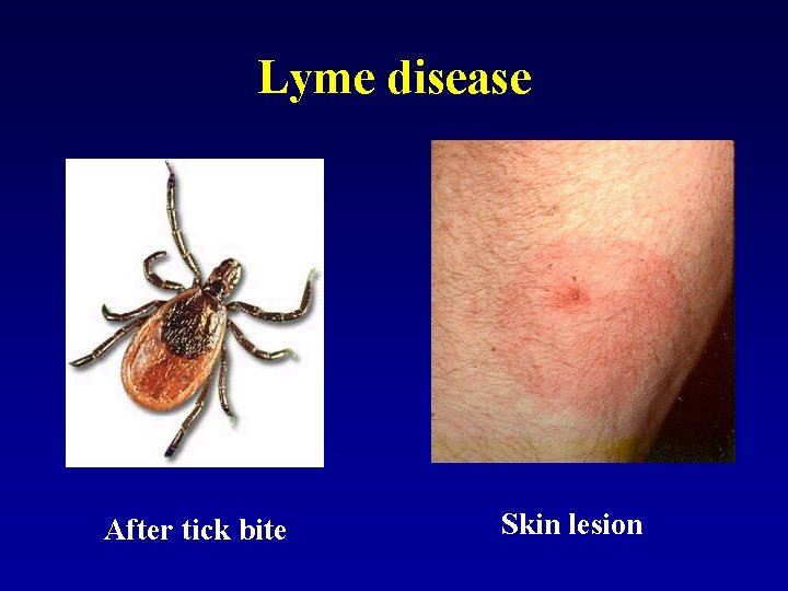 Lyme disease After tick bite Skin lesion 